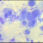 Άτυπα αδενικά κύτταρα στο κυτταρολογικό επίχρισμα του τραχήλου της μήτρας. Ενα δυνητικο πρόβλημα. ι
